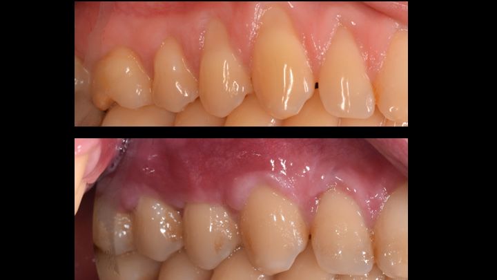 reccessions gingivales