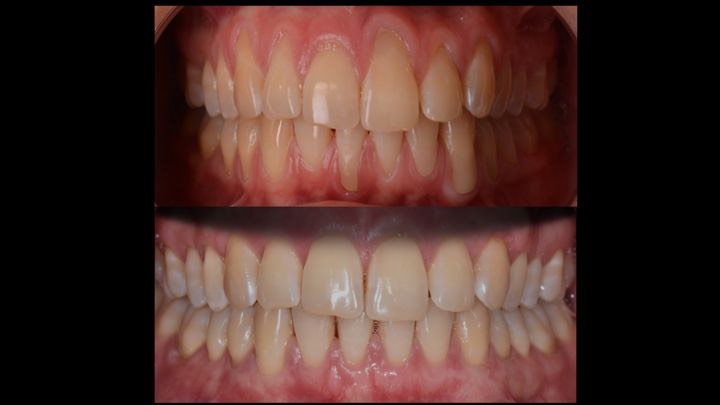 recessions gingivales Velizy