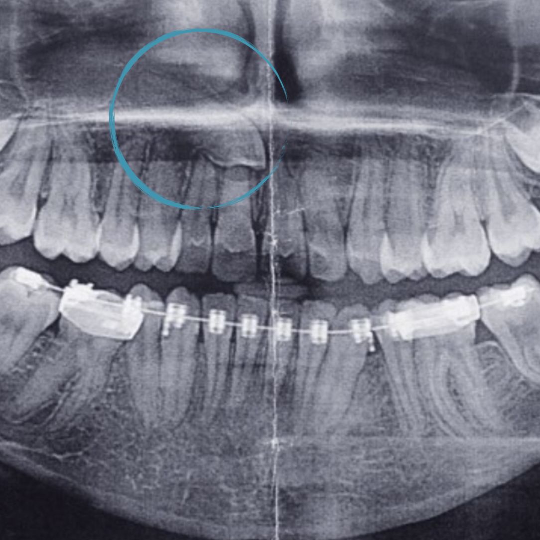 Chirurgie des dents incluses