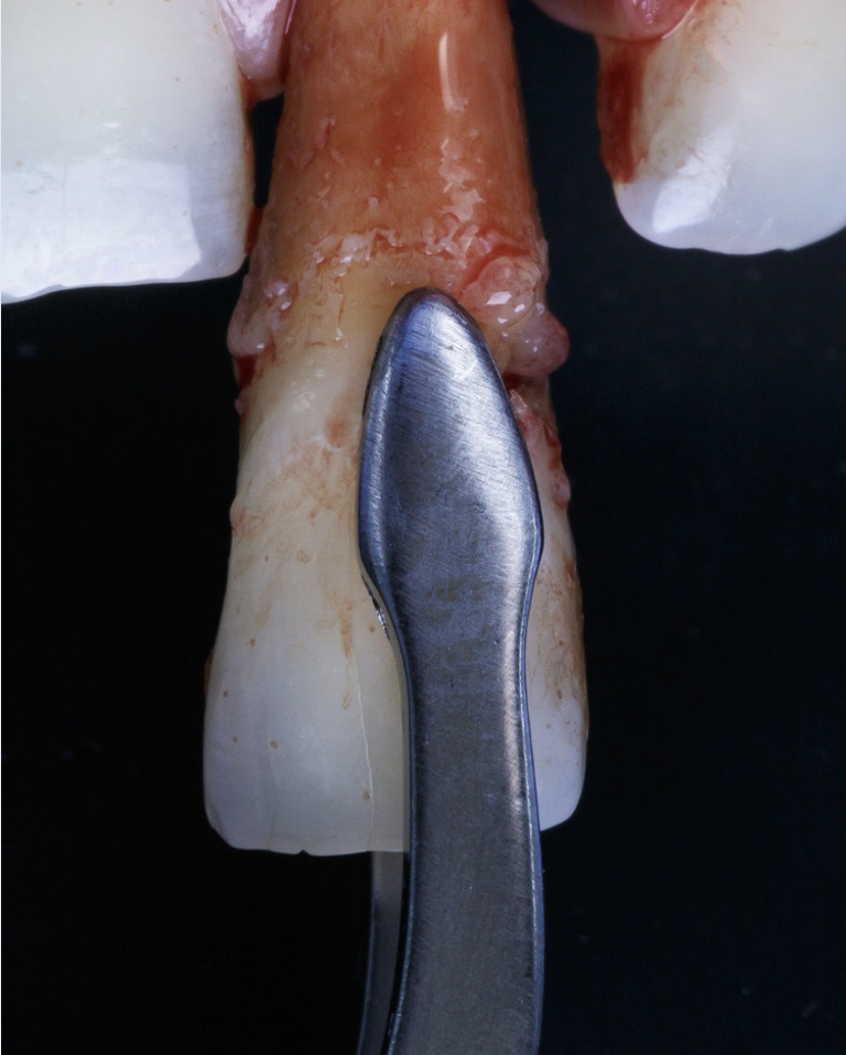 Alvéole d’extraction